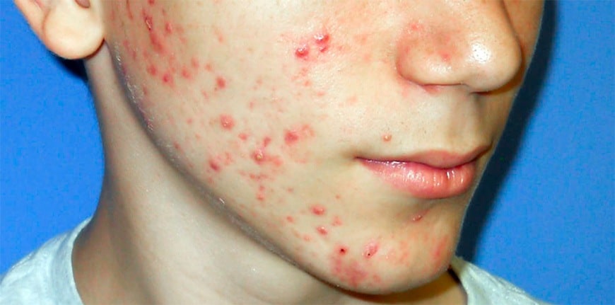 Teenage acne affects 35-40% of young adults. Why is that? What can be done about it?