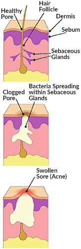 The cause of acne is goopy sebum in plugged pores