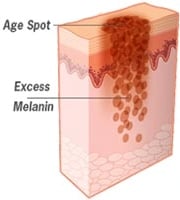 Excess melanin creates age spots
