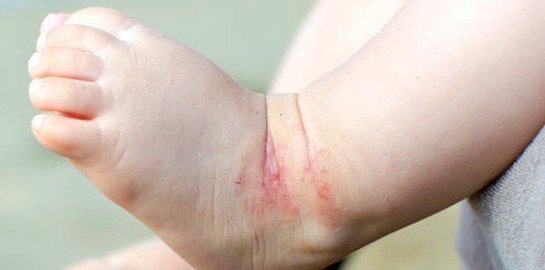 Baby eczema affects 10-15% of babies.