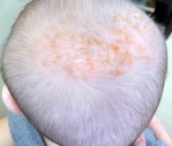 Cradle Cap (pictured) is similar, but different, from eczema
