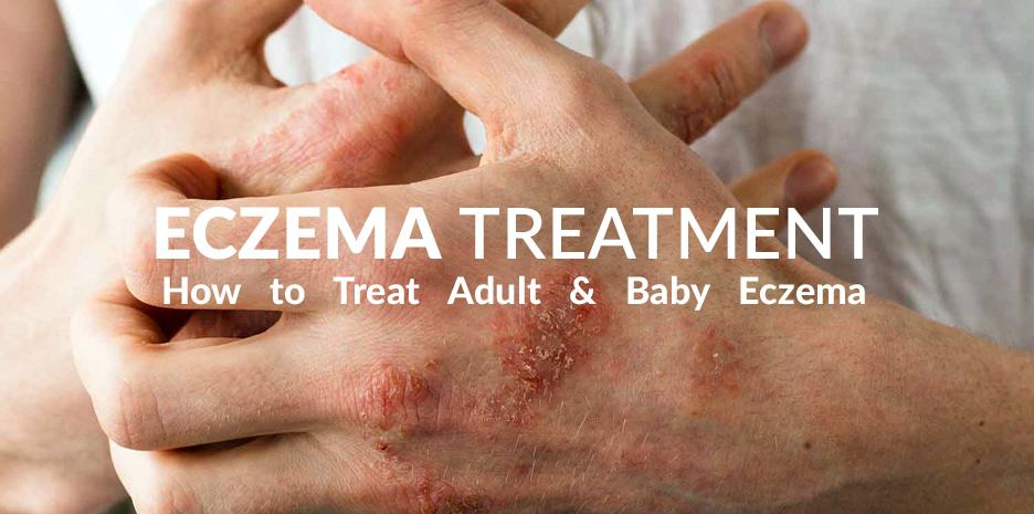 Eczema Treatment - Tips on how to treat adult and baby eczema