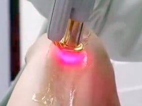 Doctor using a ND Yag laser on a scar.
