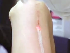 Doctor using an Erbium laser on a scar.