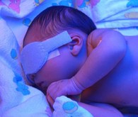 Ultraviolet light therapy can be effective in treating baby eczema