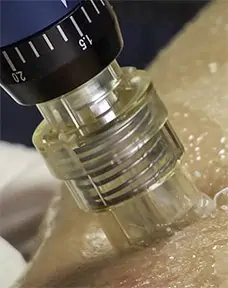 Collagen induction therapy uses a specially developed micro-needle system