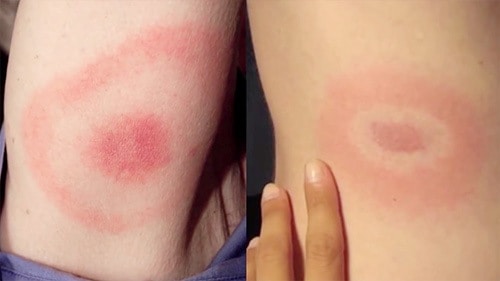 The "bullseye" rash that some people get with lyme disease