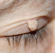 Skin Tag on Eyelid