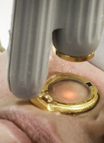 Laser treatment being performed in the crease of the nose.