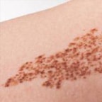 Birthmarks come in various sizes, shapes and colors