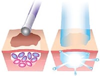 Illustrations showing how ALA is activated with a blue light