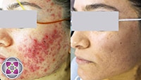 The results of laser acne treatments combined with photodynamic therapy are spectacular