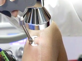 Doctor using a CO2 laser on a scar.