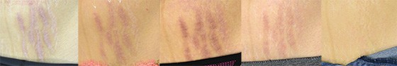 After multiple treatments the stretch marks progressively blend back into the surrounding skin