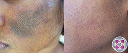 Hyperpigmentation is targeted