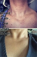Before and after age spot removal on the chest