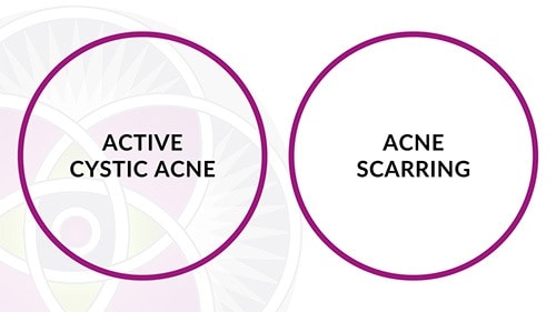 The conventional method of dealing with cystic acne involves treating the active cystic condition first