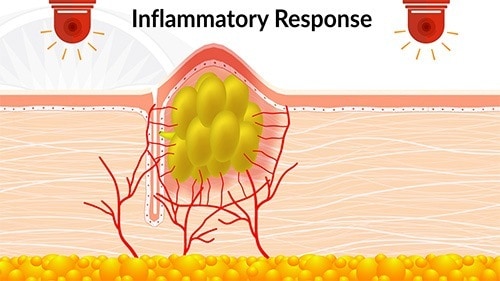 The immune inflammatory responses cause all these blood vessels to grow in to bring with them all the immune cells