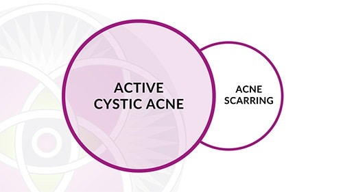With the laser protocols we have developed here we can treat both the active cystic acne and the acne scarring at the same time