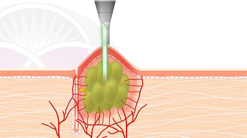 The Nd:YAG laser energy penetrates into the sebaceous gland which causes it to dry up and shrink down