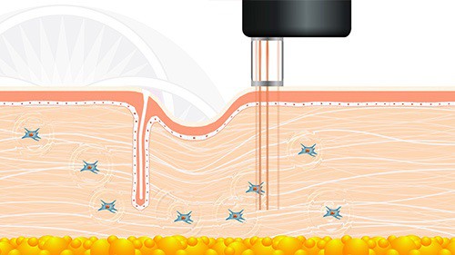 The third laser is a fractionated laser that causes the skin to contract