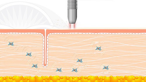 The fourth laser is an ablative laser that smooths out the surface of the skin