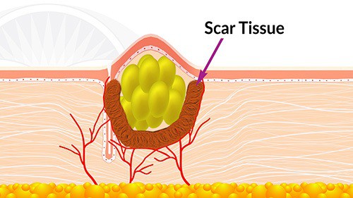 All the inflammatory tissue that surrounded the sebaceous cyst slowly turns into scar tissue