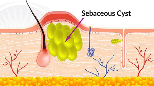 Sebaceous glands can balloon up and become sebaceous cysts