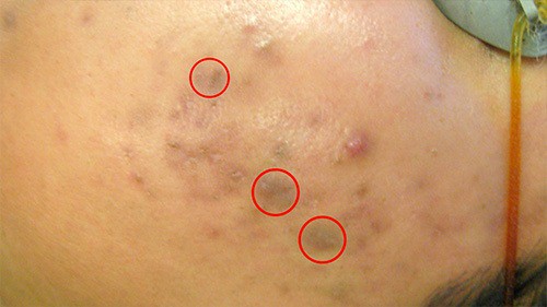 Picking at an acne blemish can cause post-inflammatory hyperpigmentation, especially in Type IV skin