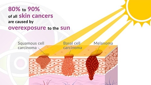 80 to 90% of all skin cancers are caused by overexposure to the sun