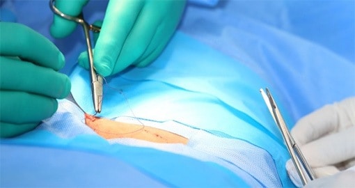 Scar revision surgery can minimize the appearance of serious scars.