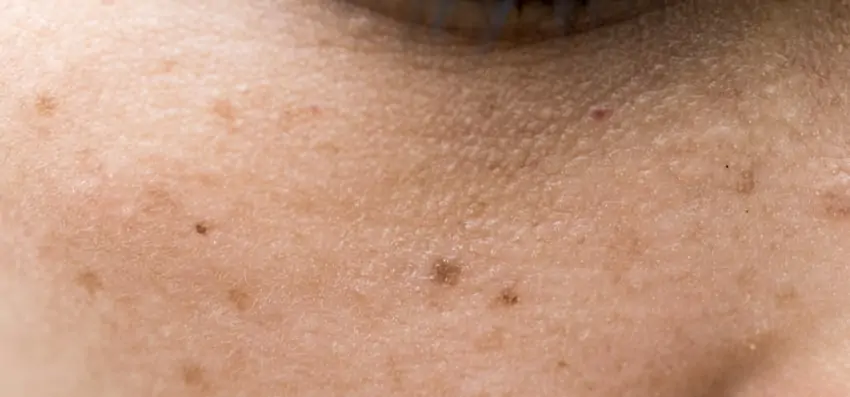Those little brown spots on your skin are lovingly referred to as freckles.