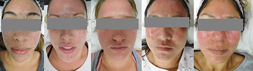 Immediately after the CO2 fractional laser treatment your skin will turn from barely pinkish red to sunburn red depending on the power used.