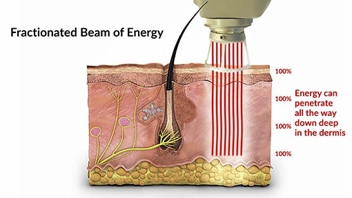 With a fractionated beam of energy the laser energy can penetrate all the way down deep into the dermis.