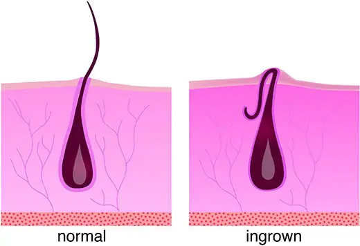 Normal hair growth on the left. What an ingrown hair looks like on the right.