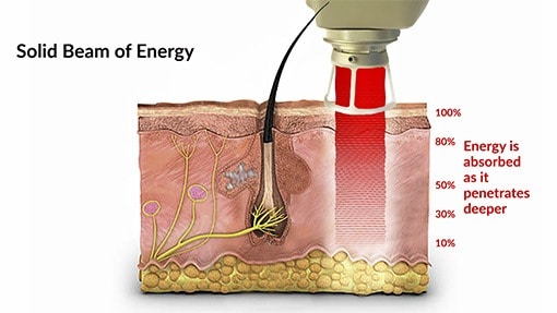 With a solid beam of energy the energy is absorbed as it penetrates deeper into the skin.