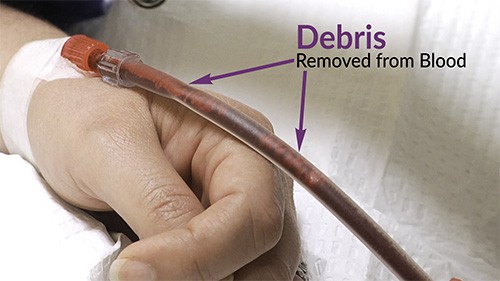 Debris being removed from the patient's blood. This debris will be captured by the EBOO/F filter. The purified, debris-free blood is then re-infused back into the patient.