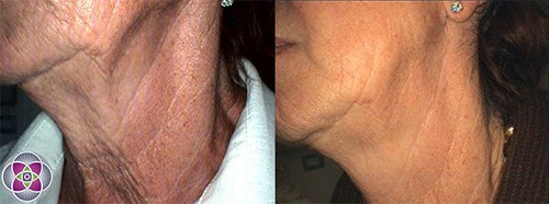 Before and after photo of radio frequency skin tightening on the neck.