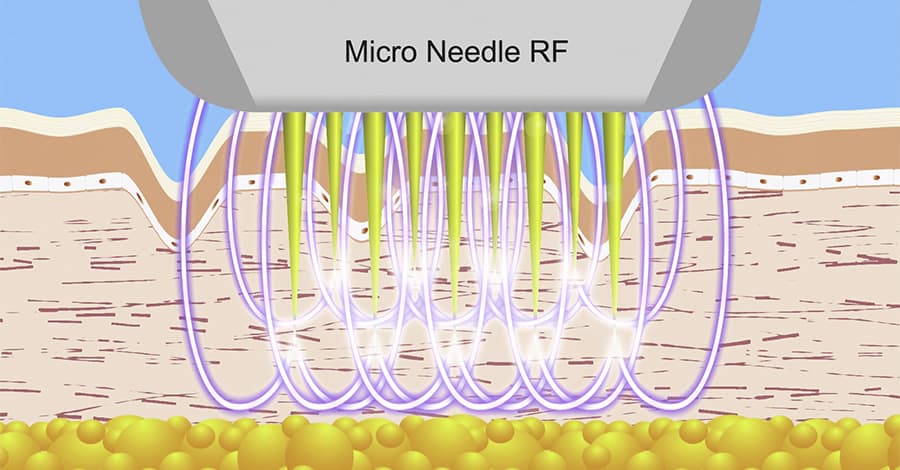 Radio frequency microneedling is an RF based technology that helps with skin tightening.