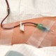 IV in patient's arm during intravenous ozone therapy treatment.