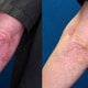 Before and after psoriasis on the left elbow being significantly reduced with ozone therapy.