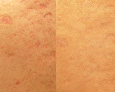 Laser Acne Scar Reduction before and after photos.