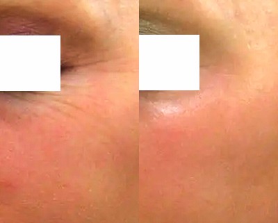 Collagen Induction Therapy before and after photos.