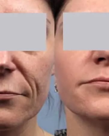Beijing Sunrise New 2024 Endolaser Non-Surgical Laser Face
