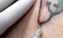 thumbs_1-injections-fmake-laser-tattoo-removal-completely-painless