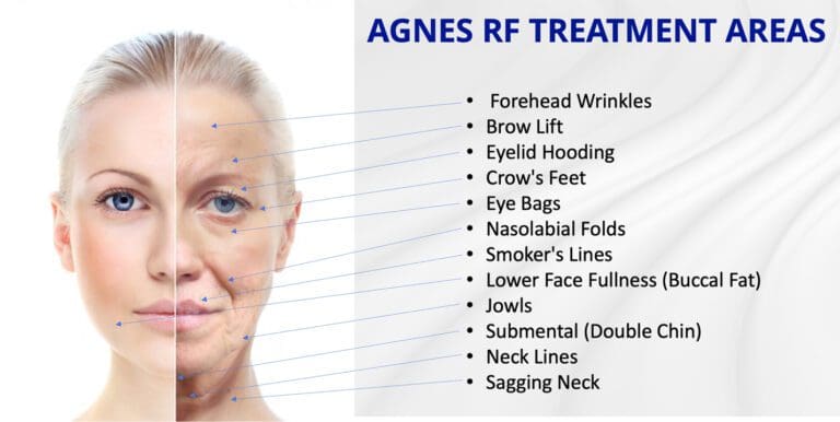 Agnes Radio Frequency Treatment | AMA Regen Med & Skincare