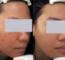 Acne removal on Asian skin