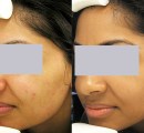 Acne laser treatment