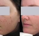 Acne laser therapy eliminates acne as seen in this before and after photo.