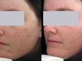 Acne laser therapy eliminates acne as seen in this before and after photo.